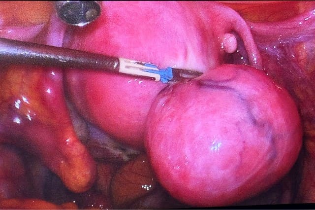 Λαπαροσκοπική Γυναικολογική Χειρουργική